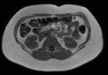 Normal liver MRI with Gadolinium (Radiopaedia 58913-66163 Axial T1 in-phase 10).jpg