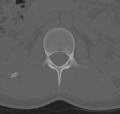 Normal lumbar spine CT (Radiopaedia 46533-50986 Axial bone window 13).png