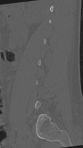 File:Normal lumbar spine CT (Radiopaedia 46533-50986 Sagittal bone window 75).png