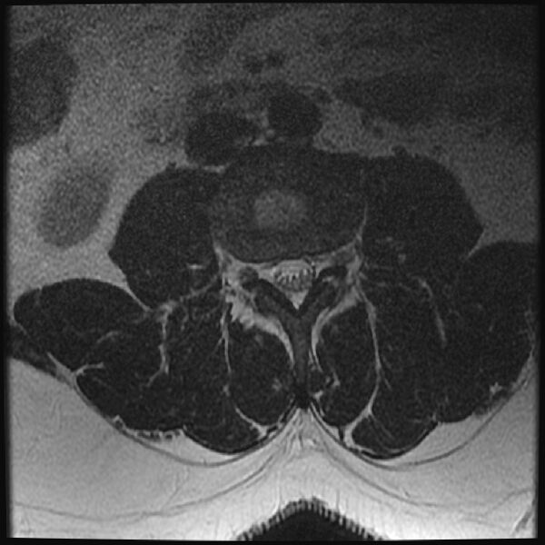 File:Normal lumbar spine MRI (Radiopaedia 43051-46311 Axial T2 12).jpg