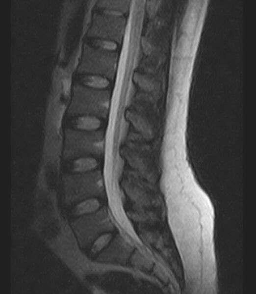 File:Normal lumbar spine MRI - low-field MRI scanner (Radiopaedia 40976-43699 Sagittal T2 6).jpg