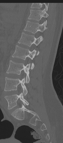 File:Normal lumbosacral CT (Radiopaedia 37923-39867 Sagittal bone window 40).png