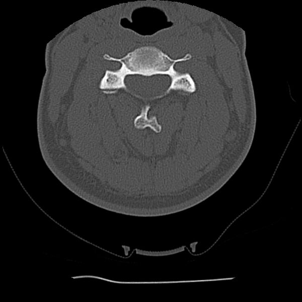 File:Normal trauma spine imaging (Radiopaedia 31753-32686 Axial bone window 36).jpg