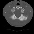 Normal trauma spine imaging (age 16) (Radiopaedia 45335-49358 Axial bone window 7).jpg