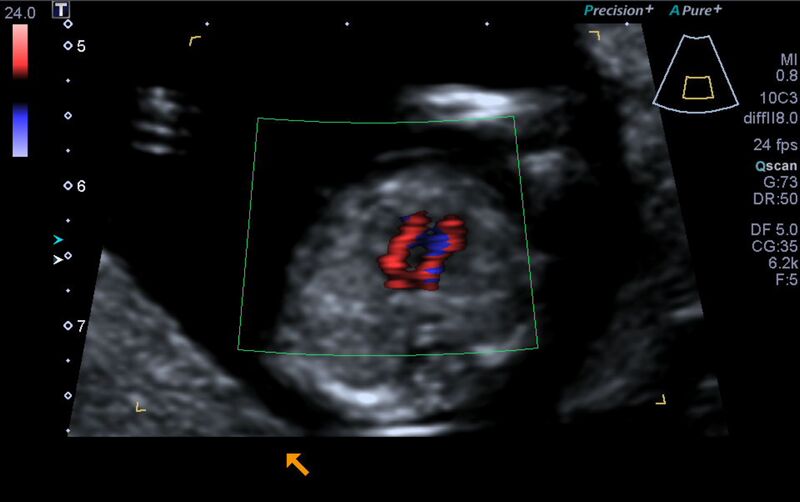 File:1st trimester nuchal-morphology ultrasound (Radiopaedia 44706-48477 Heart views cine with colour 114).jpg