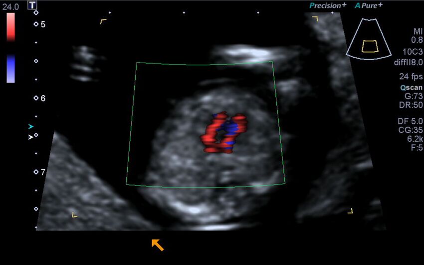 1st trimester nuchal-morphology ultrasound (Radiopaedia 44706-48477 Heart views cine with colour 114).jpg