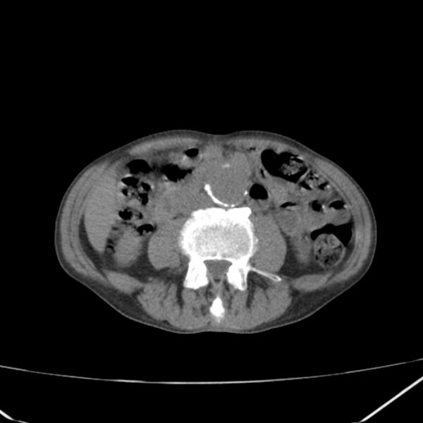 File:Abdominal aortic aneurysm (Radiopaedia 23703-23856 Axial non-contrast 29).jpg