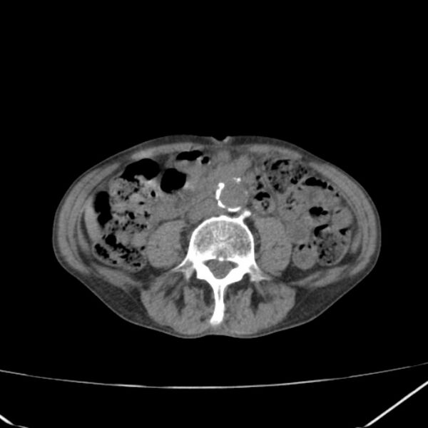 File:Abdominal aortic aneurysm (Radiopaedia 23703-23856 Axial non-contrast 31).jpg