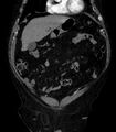 Abdominal aortic aneurysm (Radiopaedia 25855-26001 Coronal C+ arterial phase 2).jpg