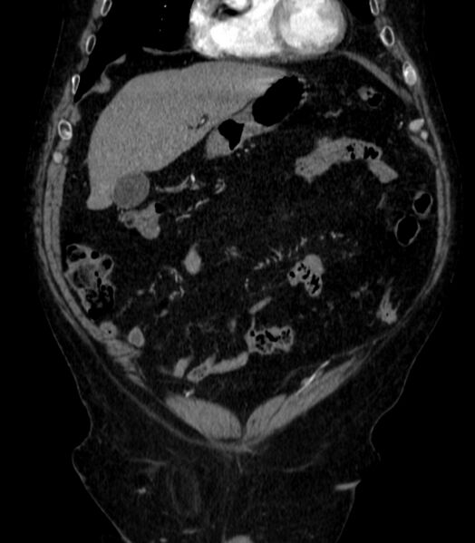 File:Abdominal aortic aneurysm (Radiopaedia 25855-26001 Coronal C+ arterial phase 2).jpg
