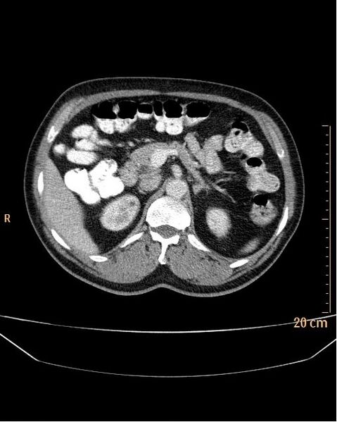File:Abdominal aortic aneurysm (Radiopaedia 25985-26121 Axial C+ arterial phase 4).jpg