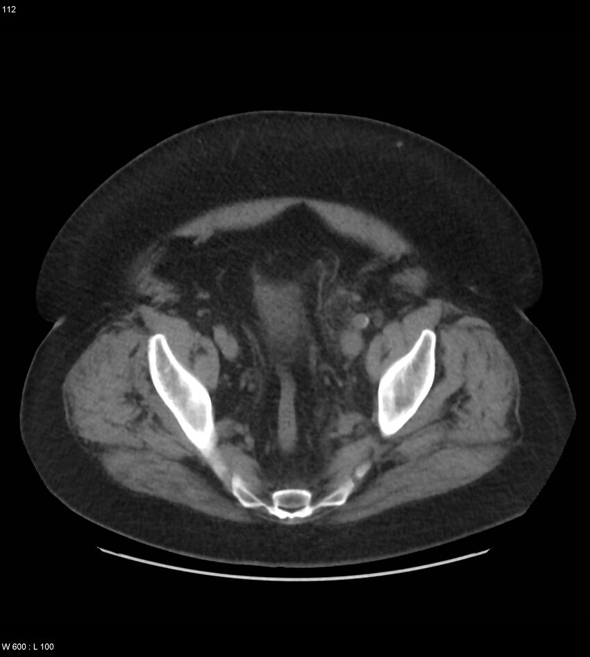 Abdominal aortic aneurysm with intramural hematoma then rupture (Radiopaedia 50278-55631 Axial non-contrast 108).jpg