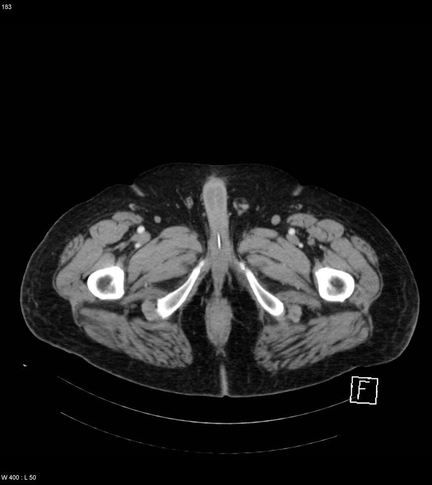 Abdominal aortic aneurysm with intramural hematoma then rupture (Radiopaedia 50278-55632 Axial C+ arterial phase 182).jpg
