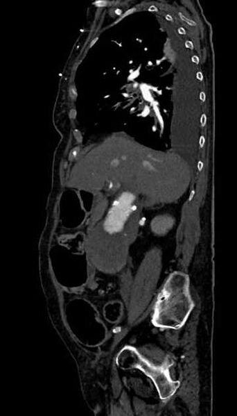 File:Abdominal aortic aneurysm with thrombus fissuration (Radiopaedia 73192-83919 Sagittal C+ arterial phase 96).jpg