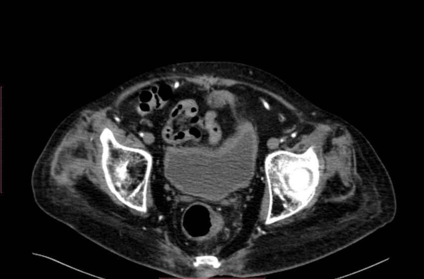 Abdominal aortic interposition tube graft and aneurysm thrombosis (Radiopaedia 71438-81857 Axial C+ arterial phase 213).jpg