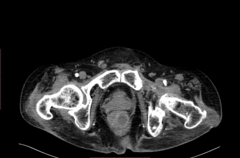 File:Abdominal aortic interposition tube graft and aneurysm thrombosis (Radiopaedia 71438-81857 Axial C+ arterial phase 245).jpg