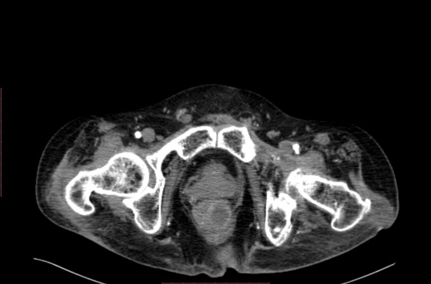 Abdominal aortic interposition tube graft and aneurysm thrombosis (Radiopaedia 71438-81857 Axial C+ arterial phase 245).jpg