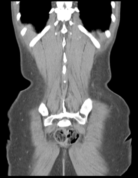 File:Abdominal desmoid tumor (Radiopaedia 41007-43740 Coronal C+ portal venous phase 36).png