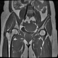 Abdominal wall endometriosis (Radiopaedia 83702-98847 Coronal T1 8).jpg