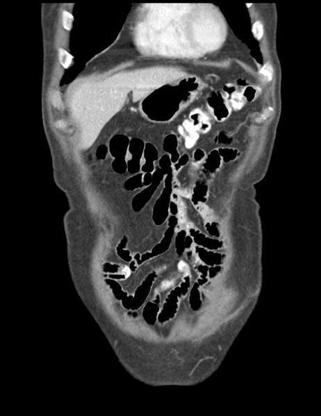 File:Abdominal wall metastasis from colorectal carcinoma (Radiopaedia 31016-31717 Coronal C+ portal venous phase 9).jpg