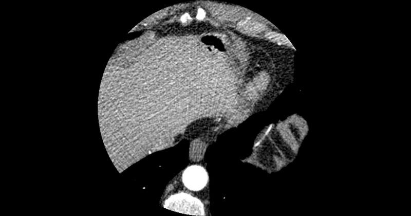 File:Aberrant left main coronary artery (ALMCA) arising from the right sinus with interarterial course (Radiopaedia 63251-71814 Axial C+ arterial phase 187).JPG