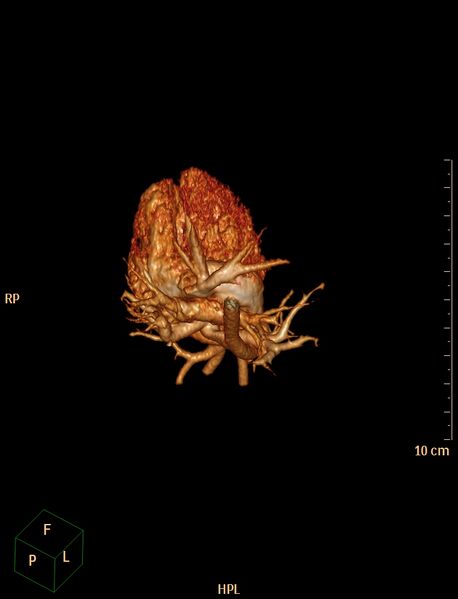 File:Aberrant left pulmonary artery (pulmonary sling) (Radiopaedia 42323-45435 3D reconstruction C+ CTPA 13).jpg