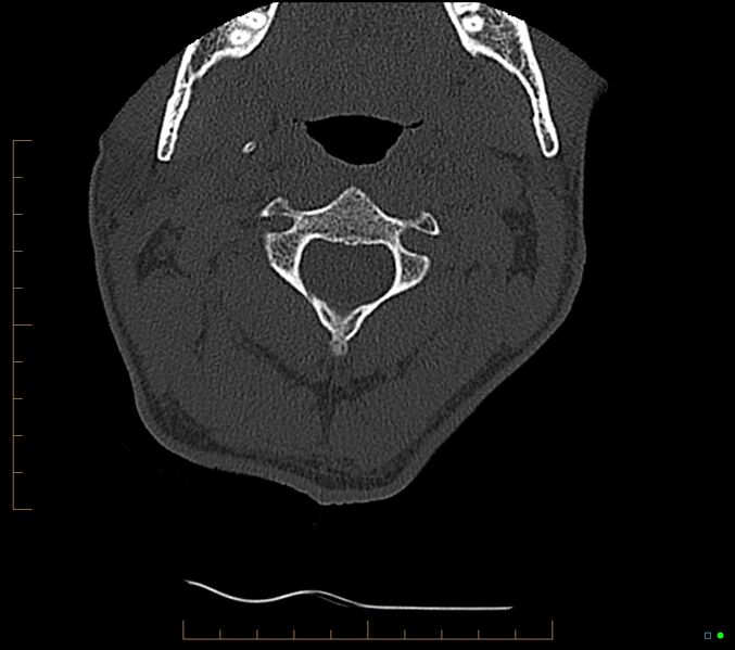 File:Accessory articulation of cervical transverse processes (Radiopaedia 82715-96933 Axial non-contrast 35).jpg