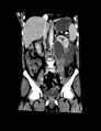 Accessory right inferior hepatic vein (Radiopaedia 33050-34067 Coronal C+ portal venous phase 4).jpg