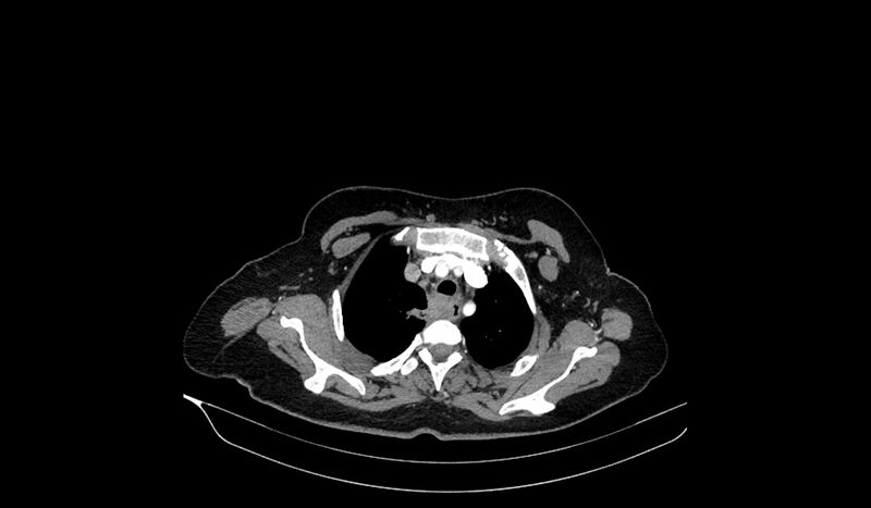 File:Acquired tracheo-esophageal fistula (Radiopaedia 51356-57103 Axial C+ arterial phase 24).jpg