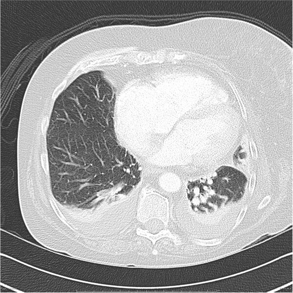 File:Acute-on-chronic pulmonary emboli (Radiopaedia 27925-28169 lung window 33).jpg