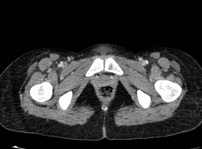 File:Acute Budd-Chiari syndrome (Radiopaedia 60858-68638 Axial C+ portal venous phase 306).jpg