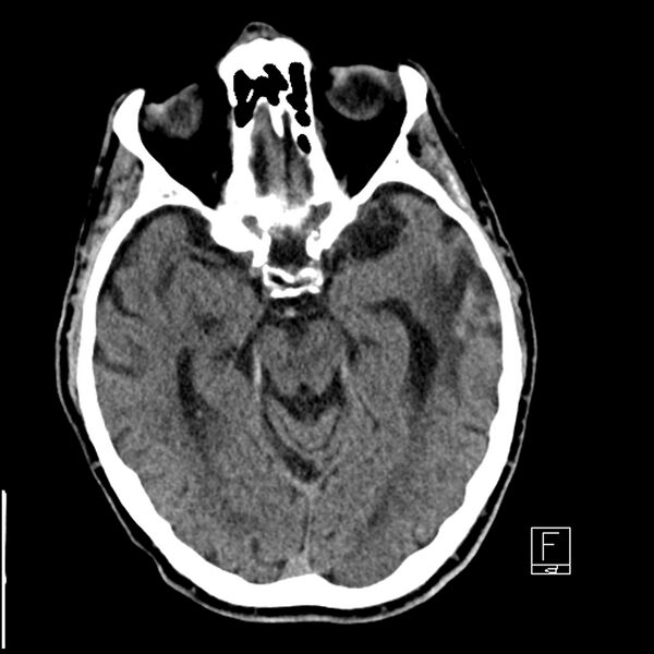 File:Acute ICA ischemic penumbra due to high-grade CCA stenosis (CT perfusion) (Radiopaedia 72038-82529 Axial non-contrast 18).jpg