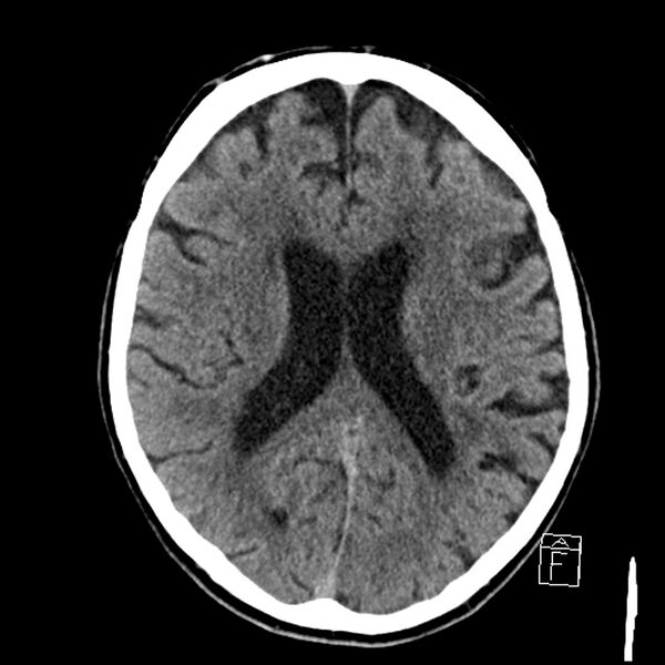 File:Acute P1 occlusion with PCA ischemia penumbra (CT perfusion) (Radiopaedia 72084-82586 Axial non-contrast 26).jpg