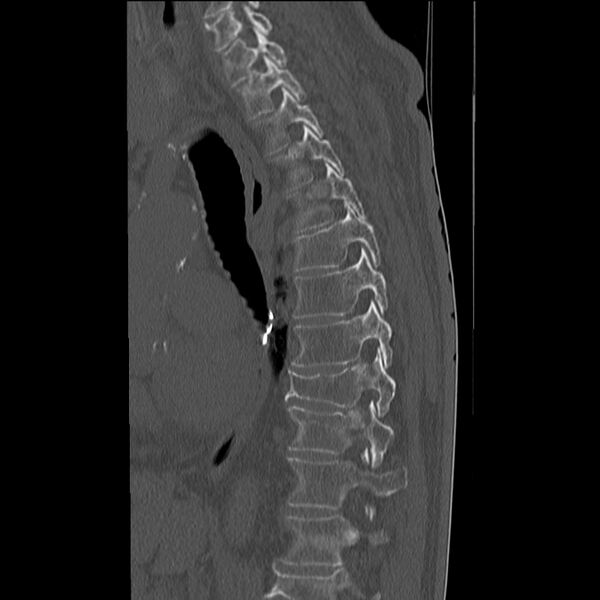 File:Acute and chronic vertebral compression fractures (Radiopaedia 31608-32494 Sagittal bone window 7).jpg