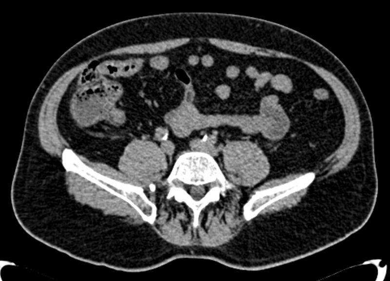 File:Acute appendicitis (Radiopaedia 13030-13091 Axial non-contrast 5).jpg