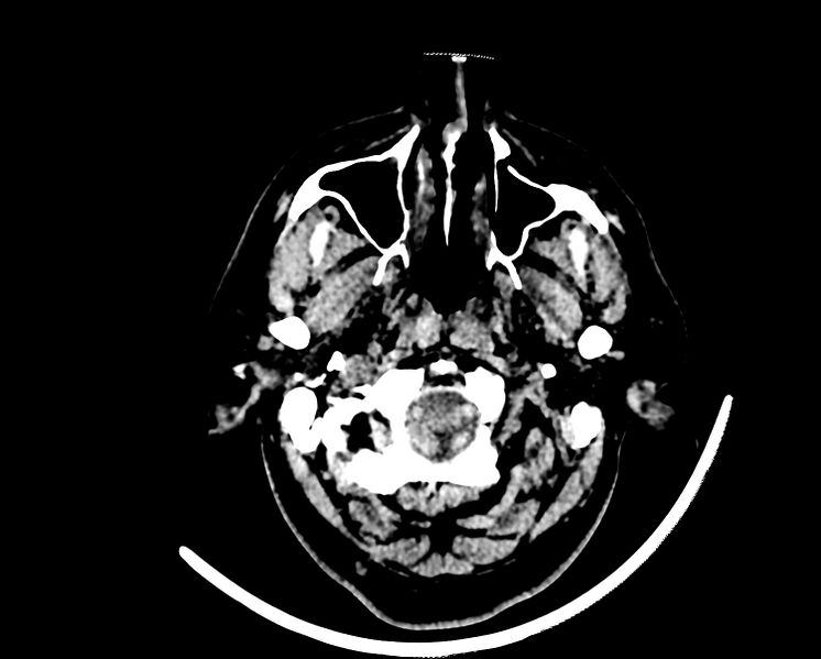 File:Acute cerebral infarct (Radiopaedia 35604-37123 Axial non-contrast 5).jpg