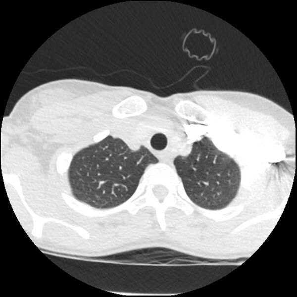 File:Acute chest syndrome - sickle cell disease (Radiopaedia 42375-45499 Axial lung window 32).jpg