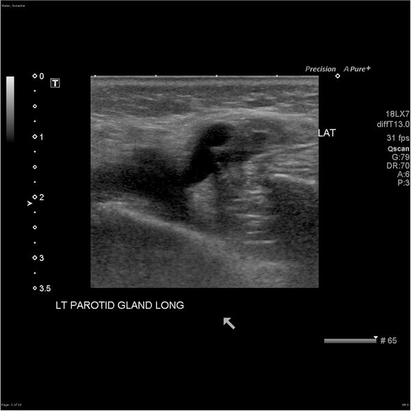 File:Acute left parotid sialadenitis (Radiopaedia 26160-26296 A 5).jpg