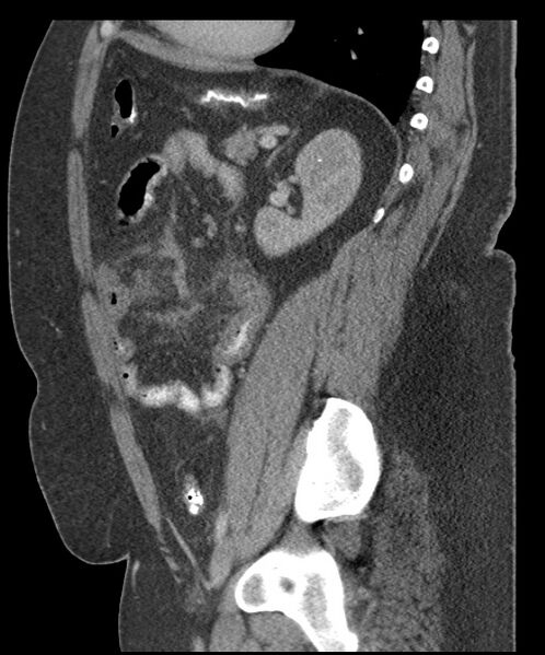File:Acute mesenteric venous ischemia (Radiopaedia 46041-50383 Sagittal C+ portal venous phase 77).jpg