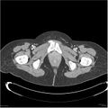 Acute pancreatitis (Radiopaedia 19136-19117 Axial C+ portal venous phase 45).jpg