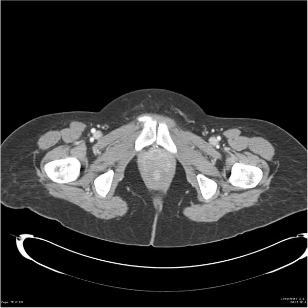 File:Acute pancreatitis (Radiopaedia 19136-19117 Axial C+ portal venous phase 45).jpg