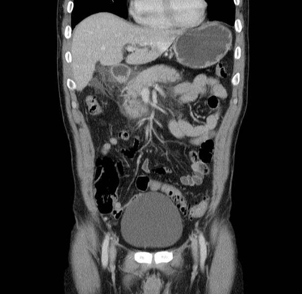 File:Acute pancreatitis (Radiopaedia 22572-22596 Coronal C+ portal venous phase 18).jpg
