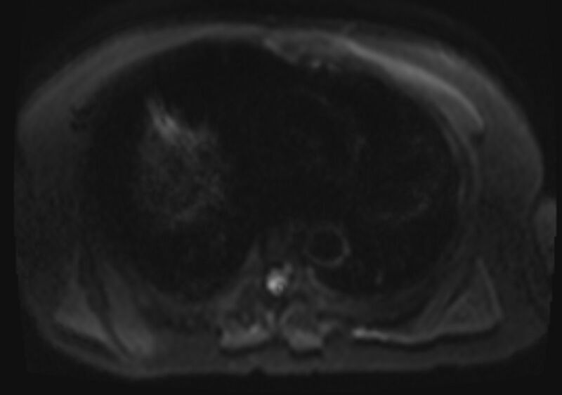 File:Acute portal vein thrombosis (Radiopaedia 73198-83925 Axial DWI 3).jpg