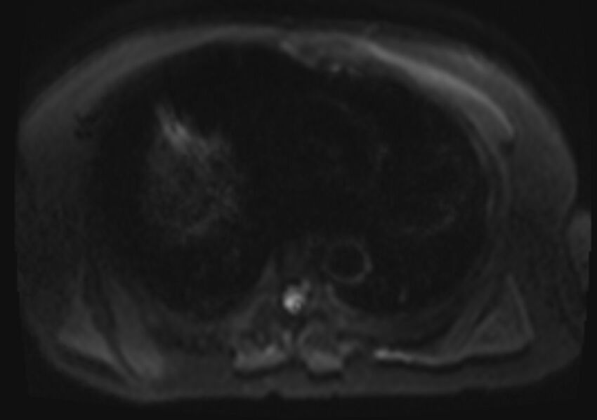Acute portal vein thrombosis (Radiopaedia 73198-83925 Axial DWI 3).jpg