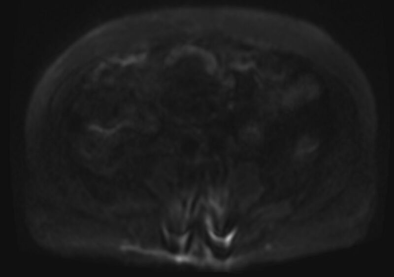 File:Acute portal vein thrombosis (Radiopaedia 73198-83925 Axial DWI 57).jpg