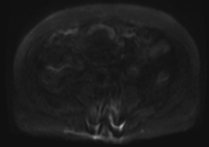 Acute portal vein thrombosis (Radiopaedia 73198-83925 Axial DWI 57).jpg