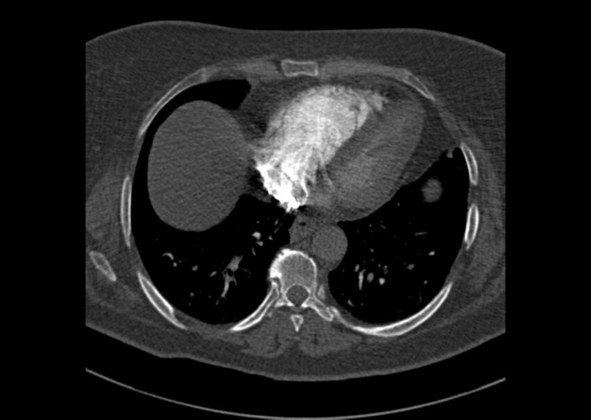 Acute pulmonary embolism (Radiopaedia 29938-30466 Axial C+ CTPA 158).jpg