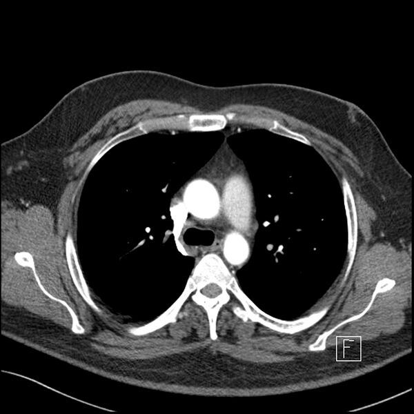 File:Acute pulmonary embolism with pulmonary infarct (Radiopaedia 73062-83768 Axial C+ CTPA 25).jpg
