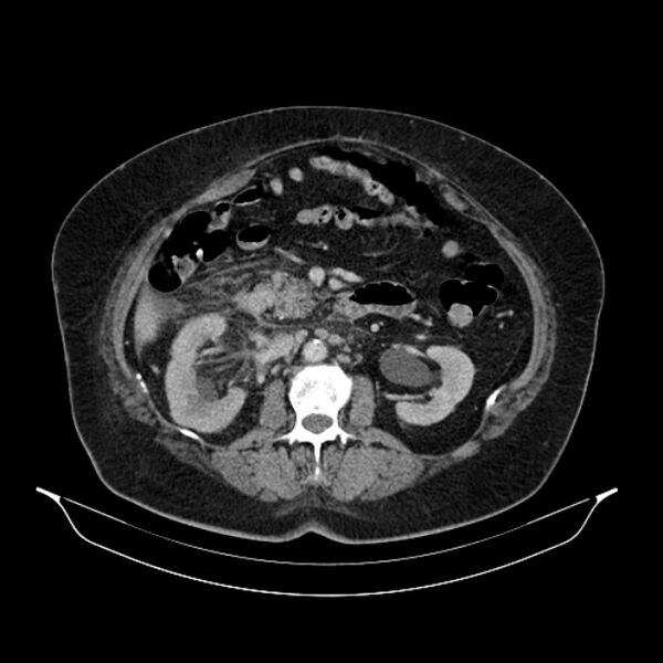 File:Acute pyelonephritis (Radiopaedia 25657-25837 Axial renal parenchymal phase 37).jpg