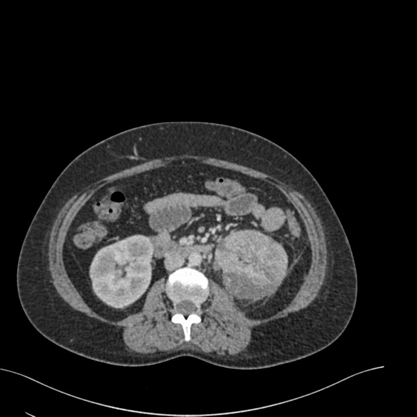 Acute pyelonephritis with renal vein thrombosis (Radiopaedia 58020-65053 Axial renal parenchymal phase 87).jpg